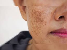 चेहरे पर किसी भी तरह के निशान, दाग-धब्बे या कील-मुंहासे से हैं परेशान तो करें ये उपाय 