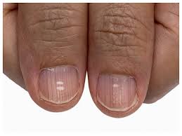  नाखून भी करते हैं कैल्शियम की कमी का इशारा 